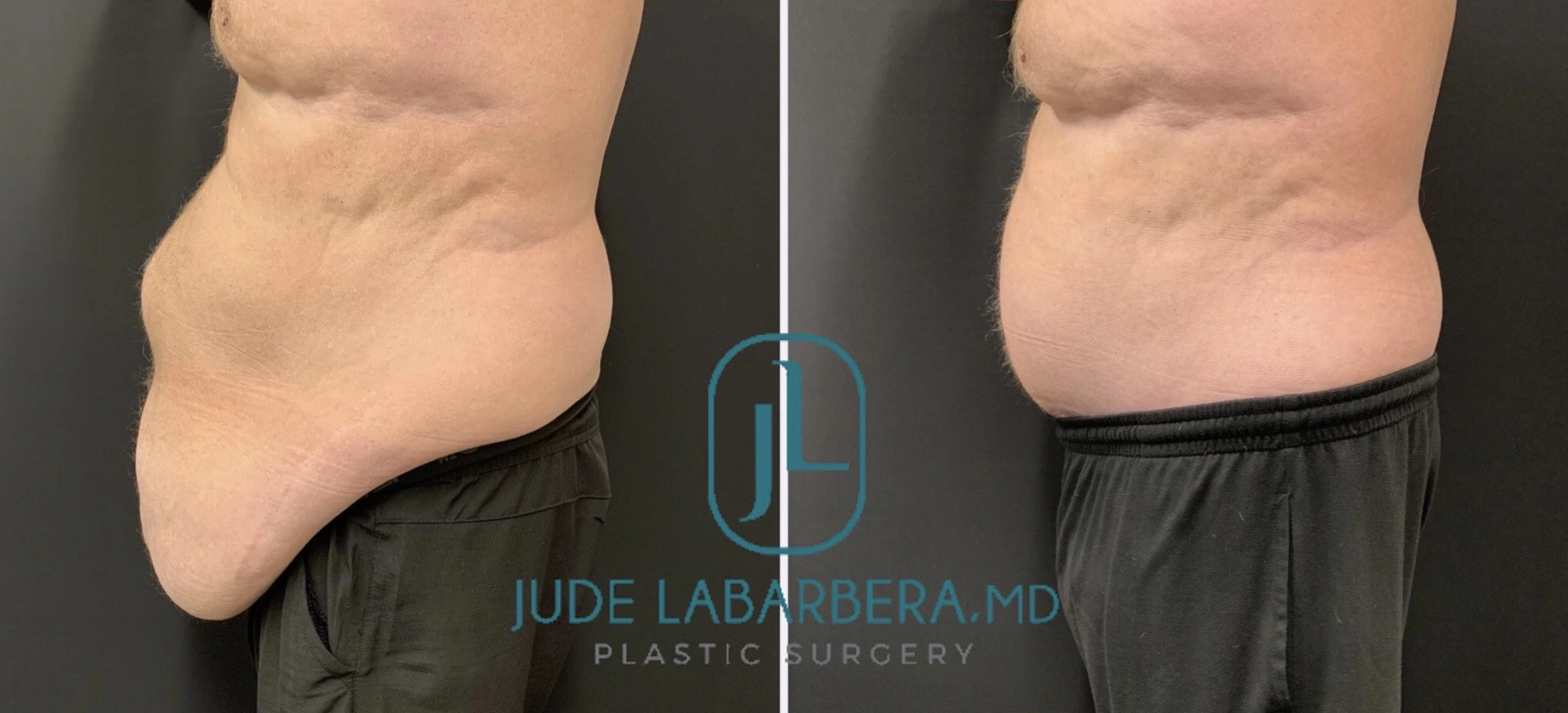 MALE TUMMY TUCK Before & After Case Number 00098