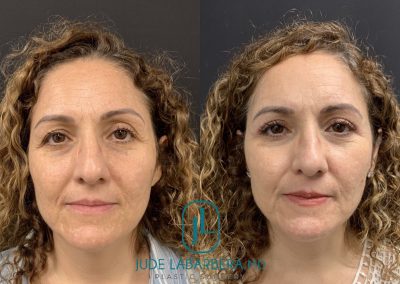 EYELID SURGERY Before & After