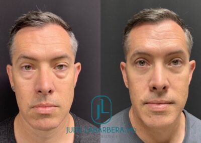 EYELID SURGERY Before & After