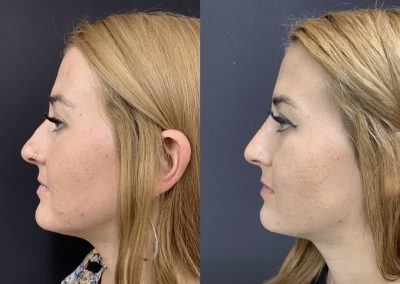NON-SURGICAL NOSE JOB Before & After
