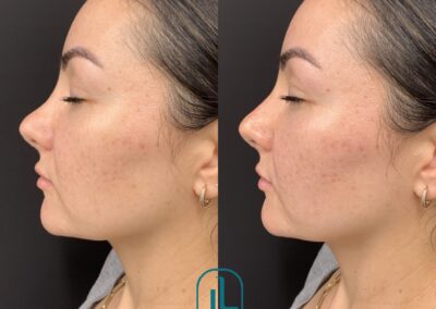 NON-SURGICAL NOSE JOB Before & After