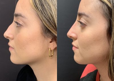 NON-SURGICAL NOSE JOB Before & After