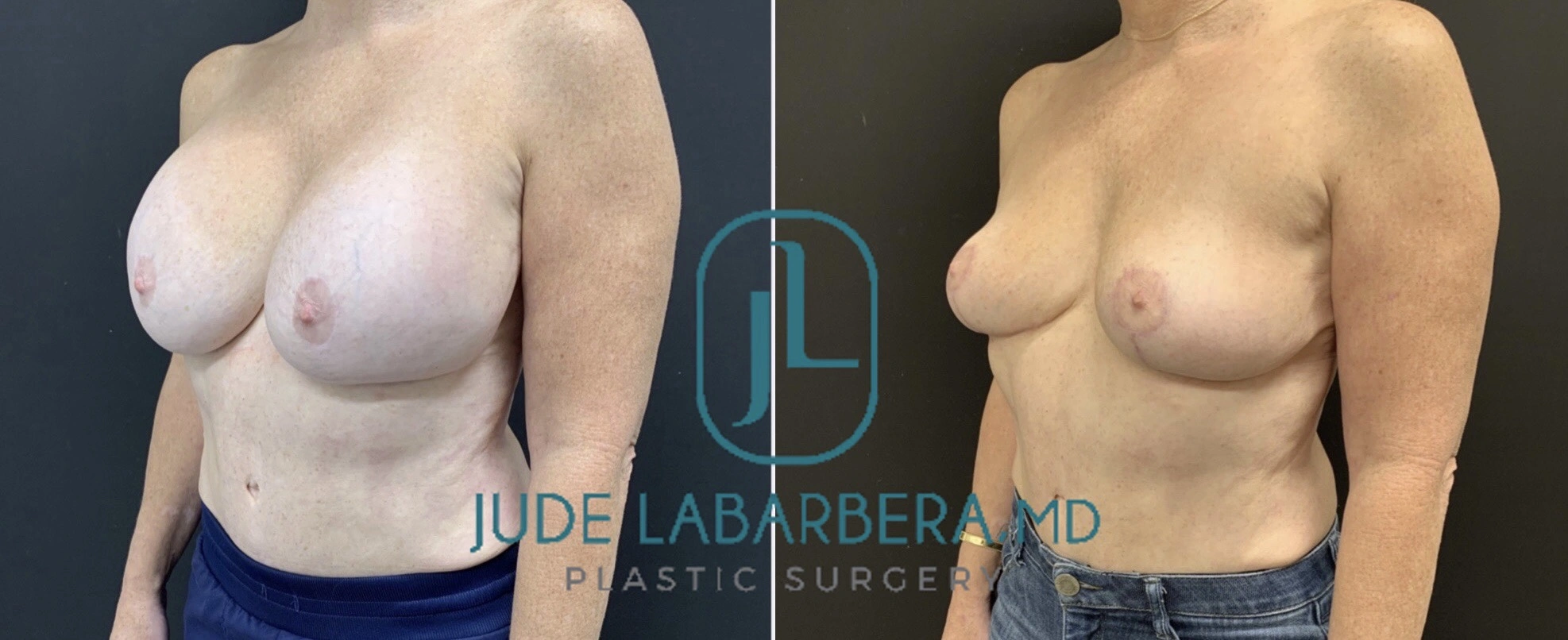 REVISION BREAST SURGERY Before & After Case Number 0006