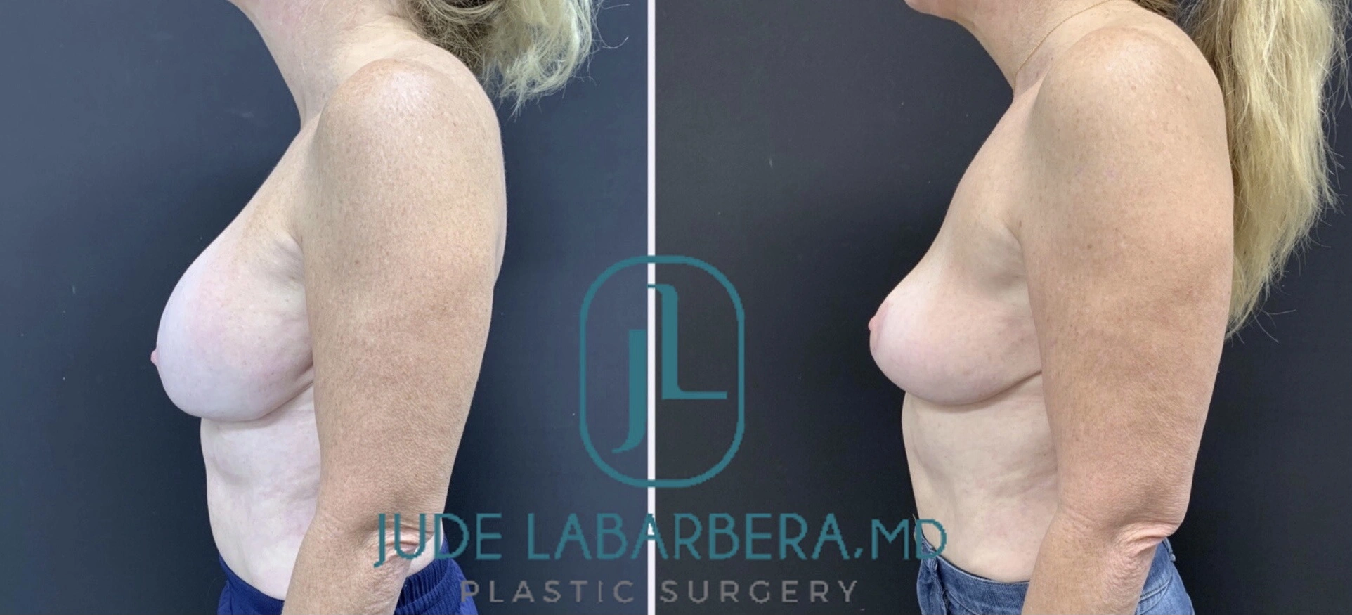 REVISION BREAST SURGERY Before & After Case Number 0006