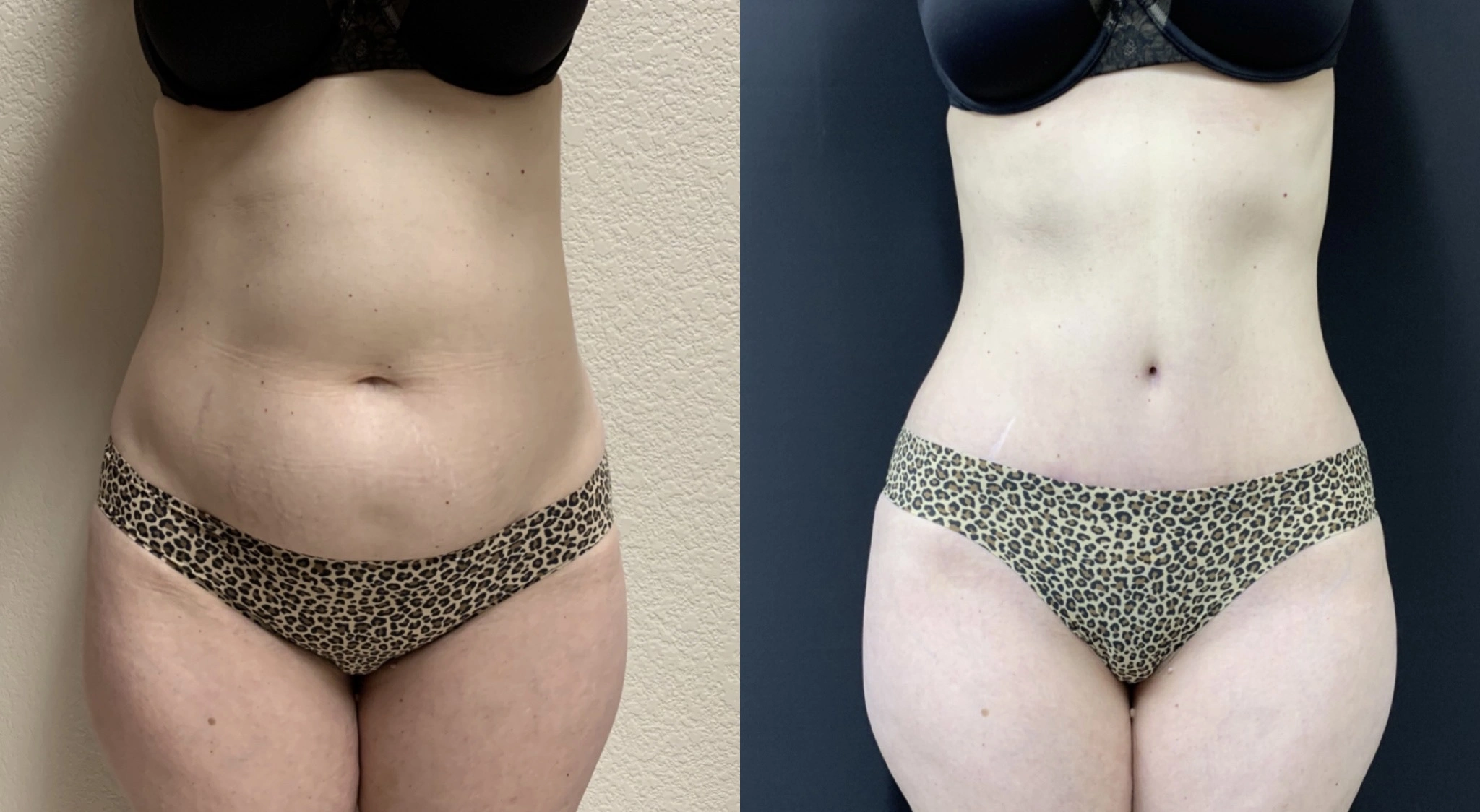 STUNNING TUMMY TUCK Before & After Case Number 000116