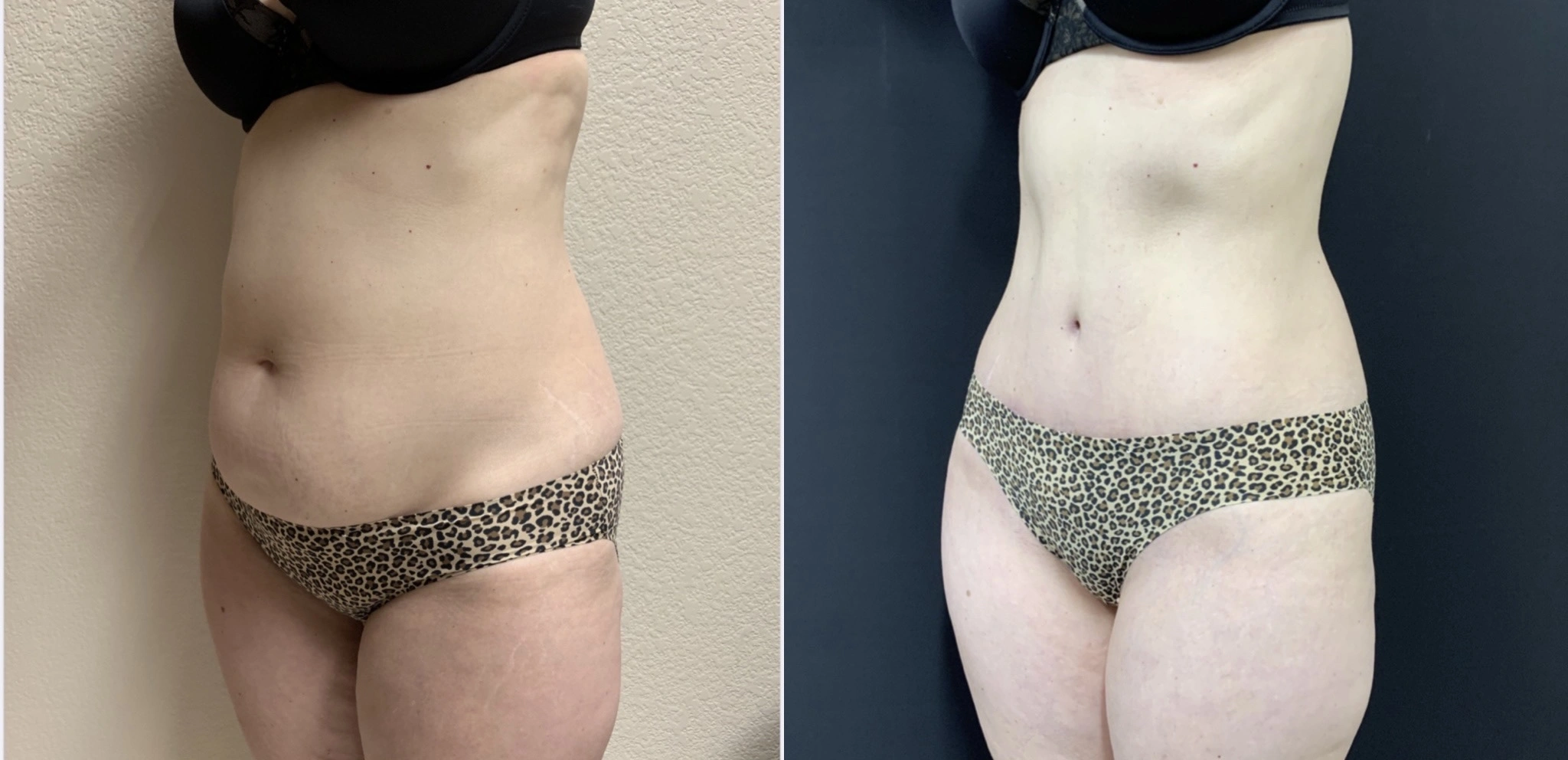 STUNNING TUMMY TUCK Before & After Case Number 000116