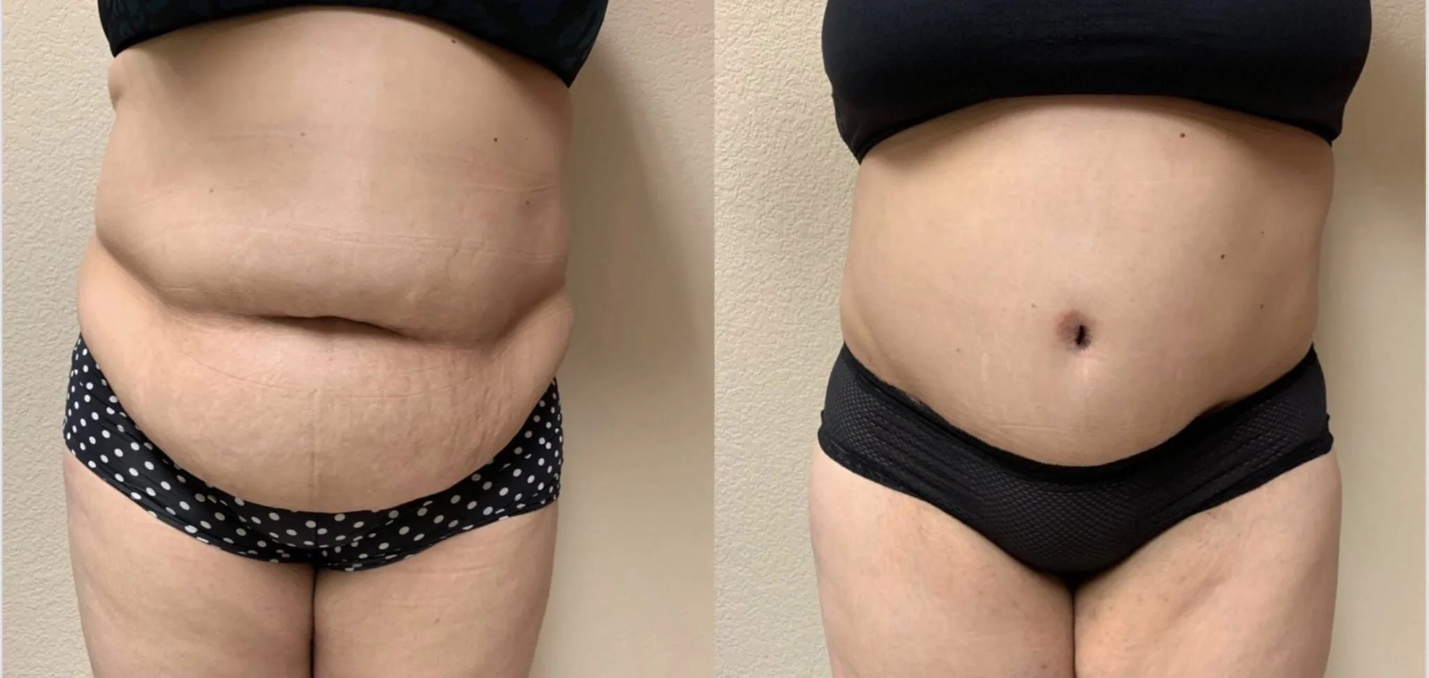 Tummy Tuck Before & After case 321