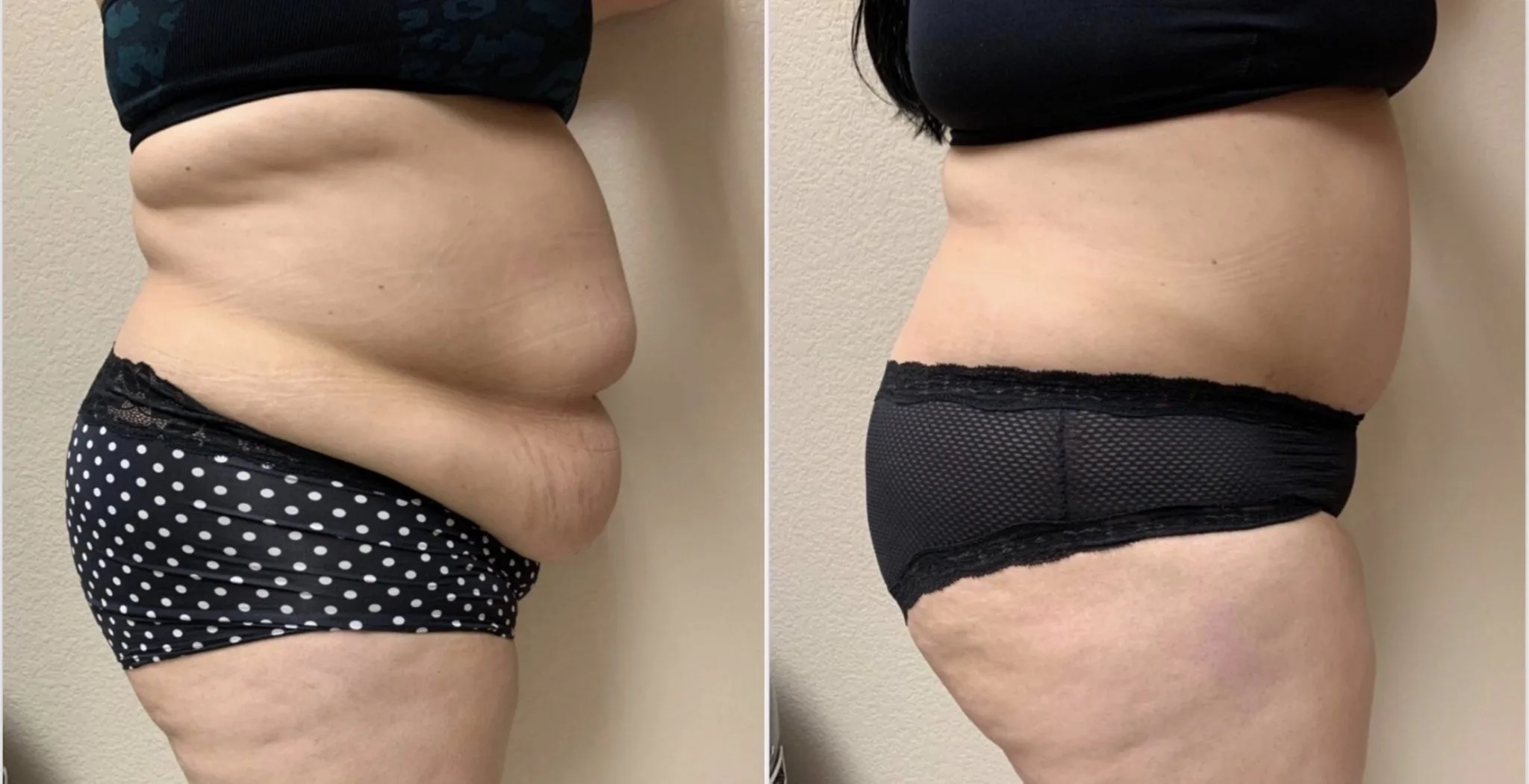 Tummy Tuck Before & After case 321