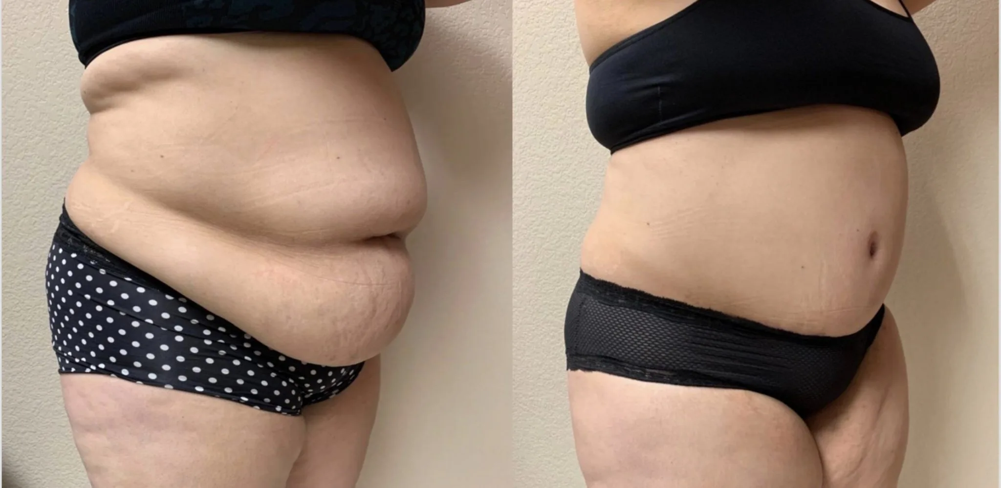 Tummy Tuck Before & After case 321