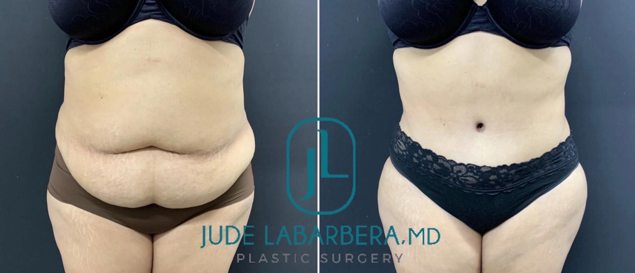 TUMMY TUCK Before & After Case Number 000100
