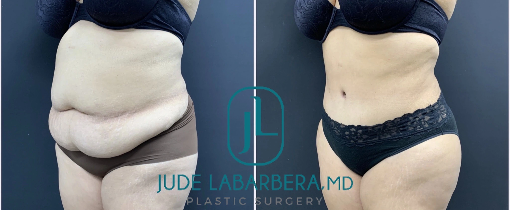 TUMMY TUCK Before & After Case Number 000100