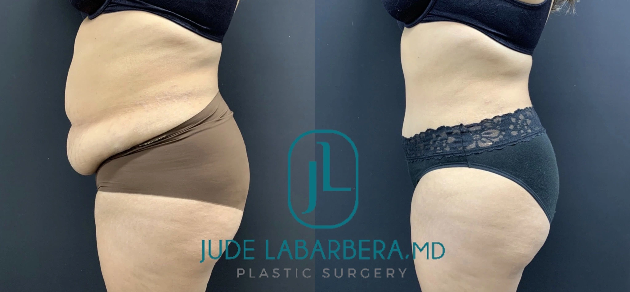 TUMMY TUCK Before & After Case Number 000100