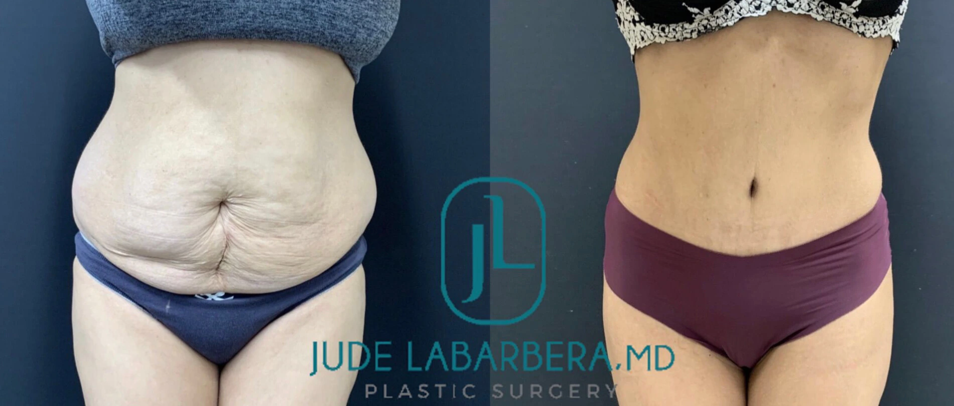 TUMMY TUCK Before & After Case Number 000102