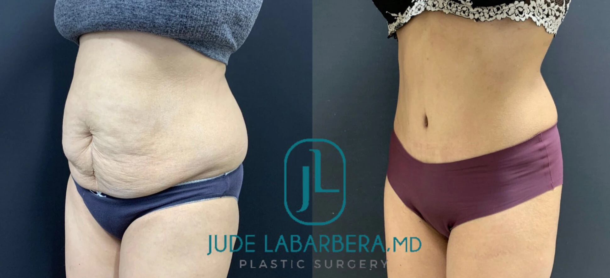 TUMMY TUCK Before & After Case Number 000102