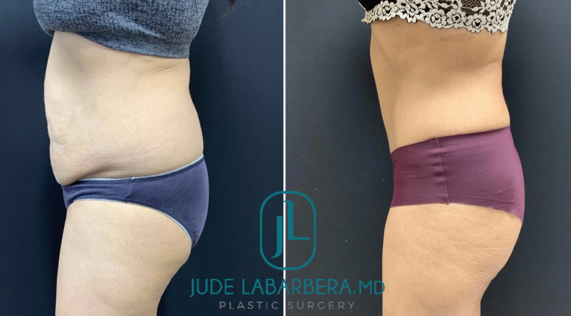 TUMMY TUCK Before & After Case Number 000102