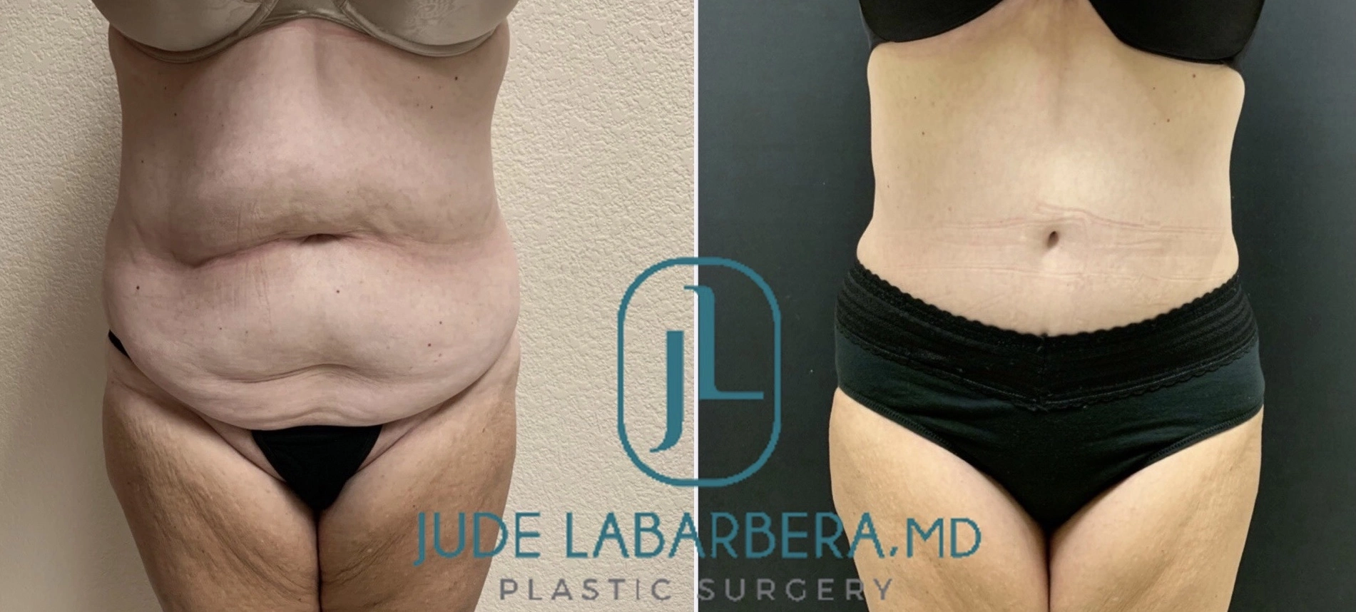 TUMMY TUCK Before & After Case Number 000107
