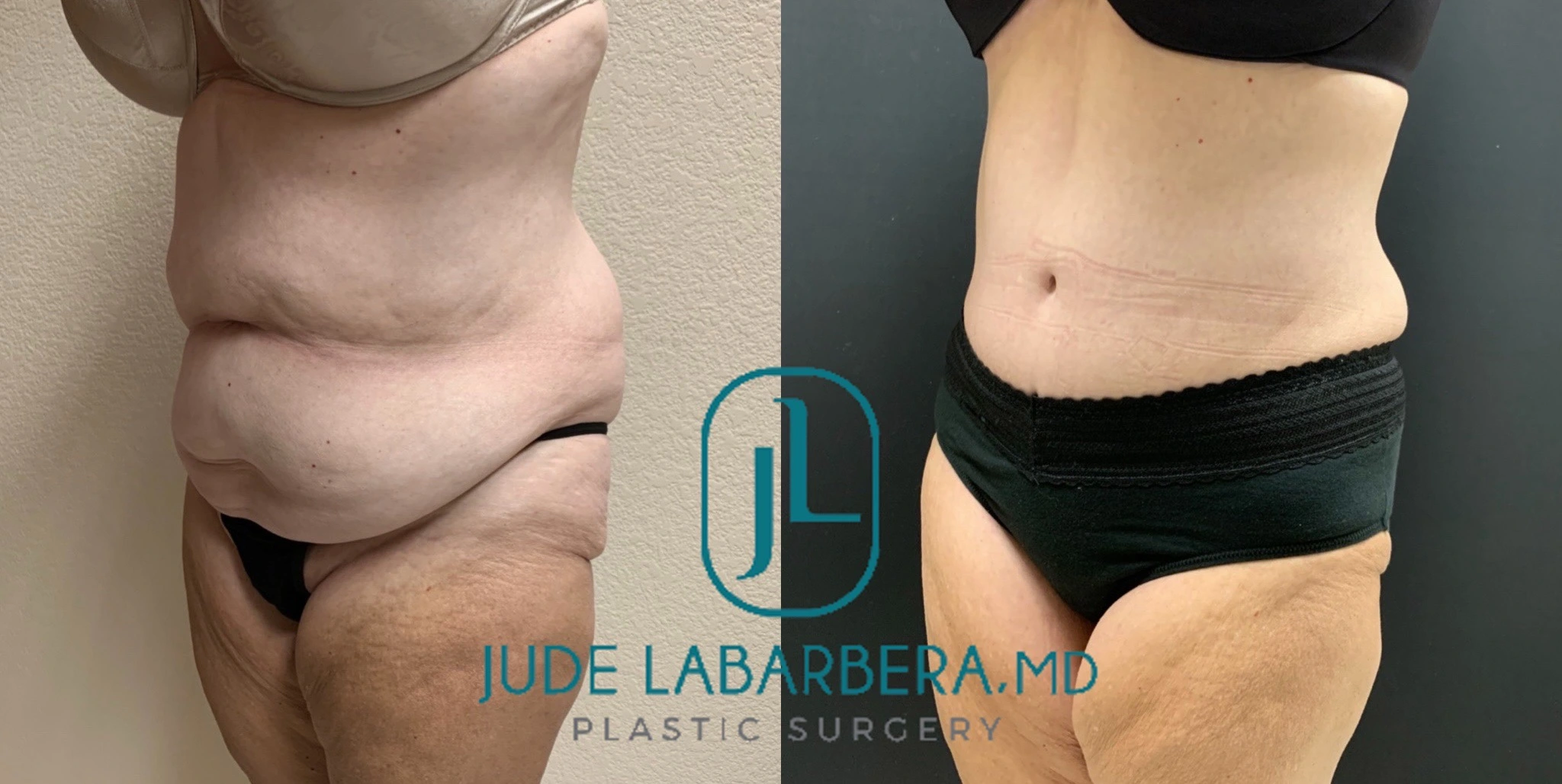 TUMMY TUCK Before & After Case Number 000107