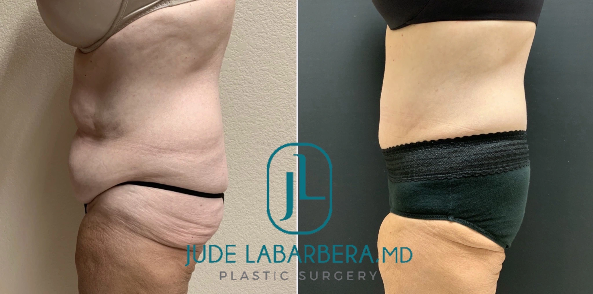 TUMMY TUCK Before & After Case Number 000107