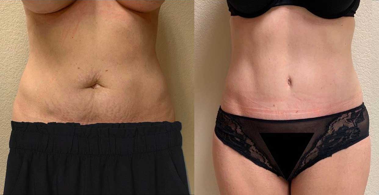 Tummy Tuck Before & After Case Number 00019