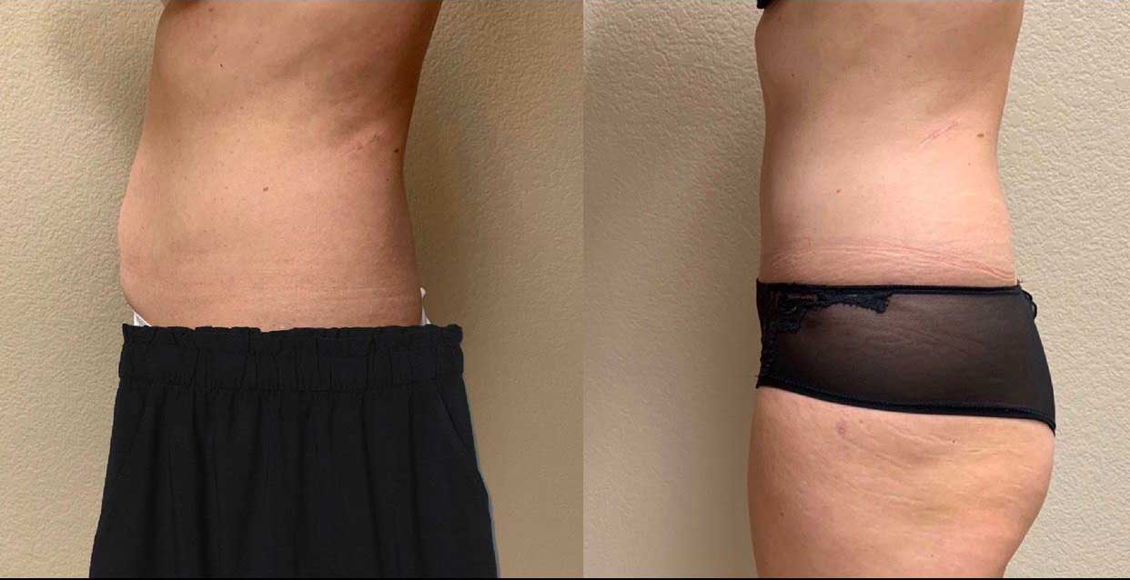 Tummy Tuck Before & After Case Number 00019