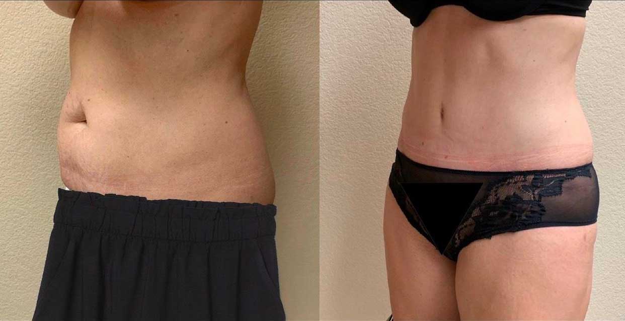 Tummy Tuck Before & After Case Number 00019