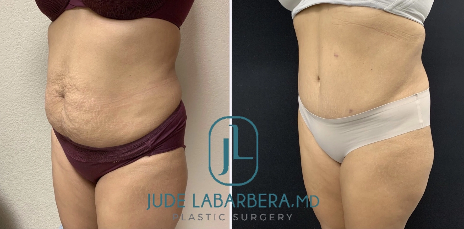 Tummy Tuck Before & After Case Number 00022