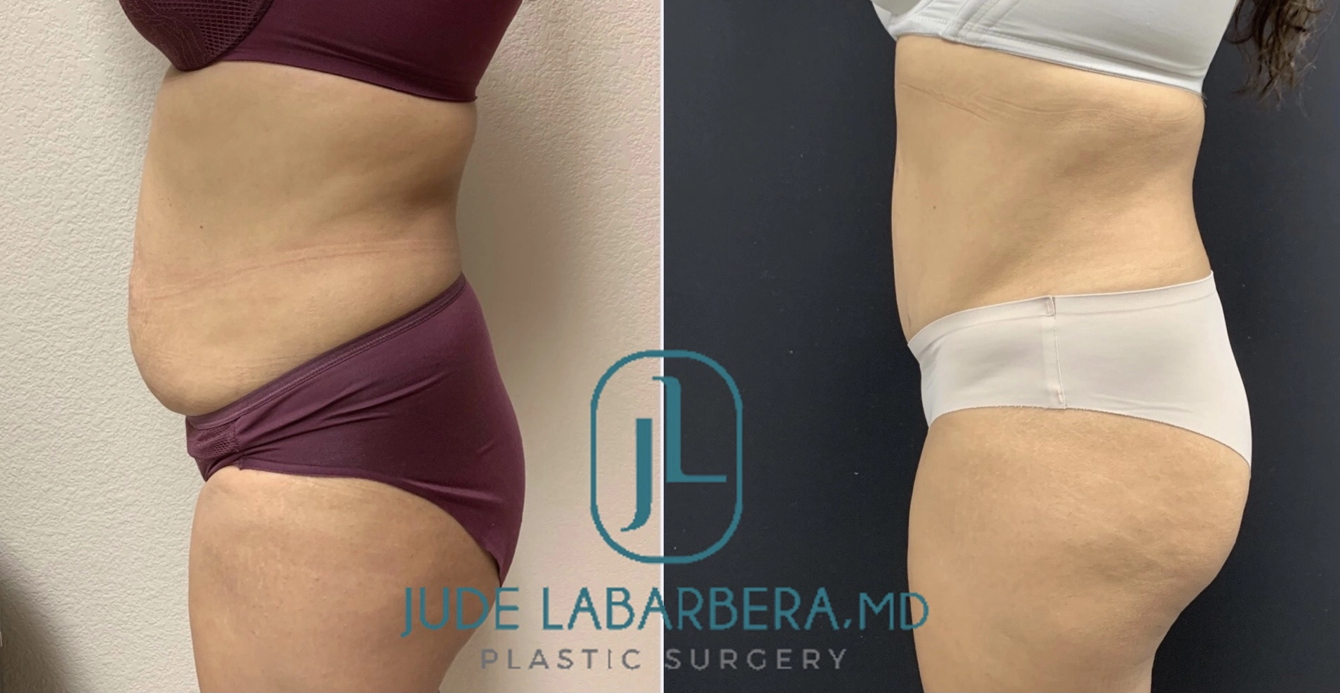 Tummy Tuck Before & After Case Number 00022