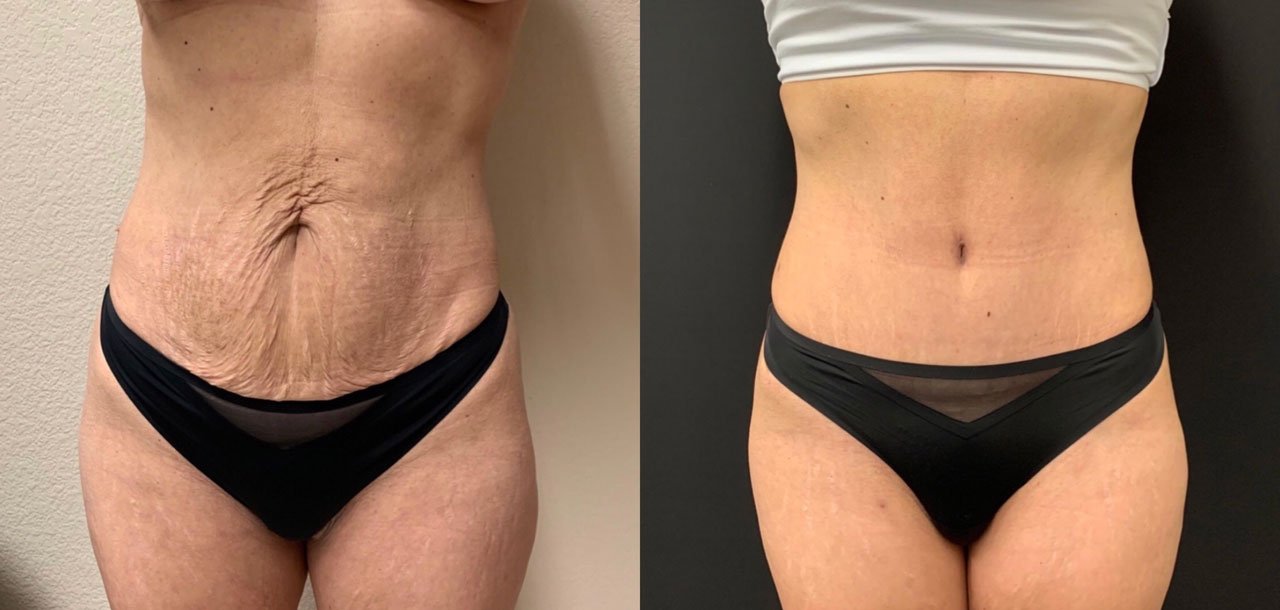 TUMMY TUCK Before & After Case Number 00057