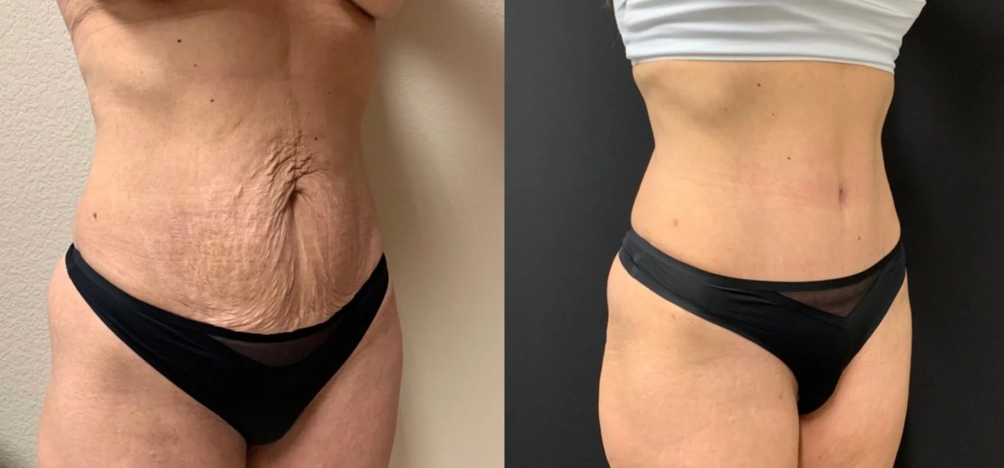 TUMMY TUCK Before & After Case Number 00057