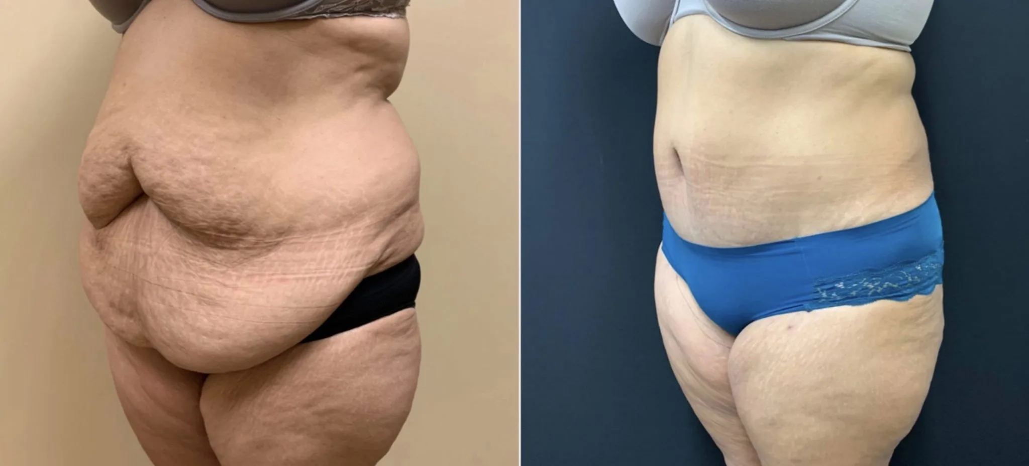 TUMMY TUCK Before & After Case Number 00058