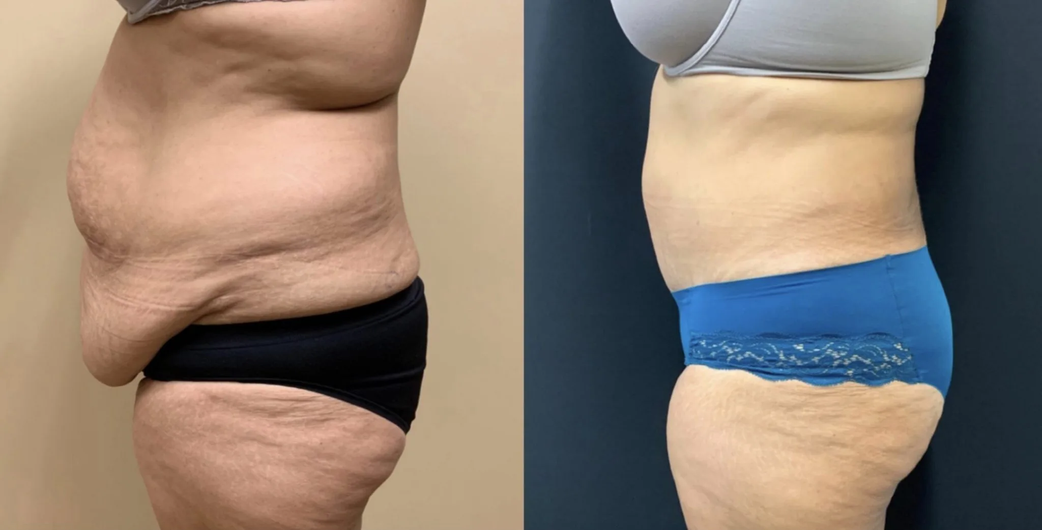 TUMMY TUCK Before & After Case Number 00058