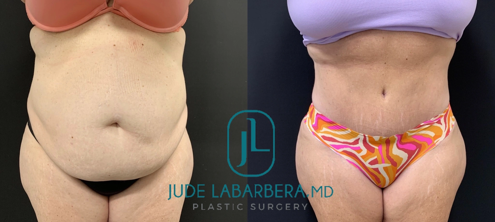 TUMMY TUCK Before & After Case Number 00084