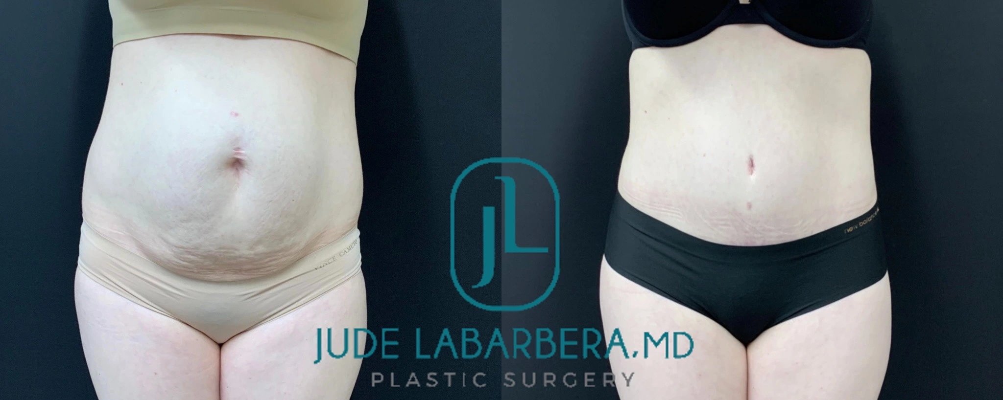 TUMMY TUCK Before & After Case Number 00090