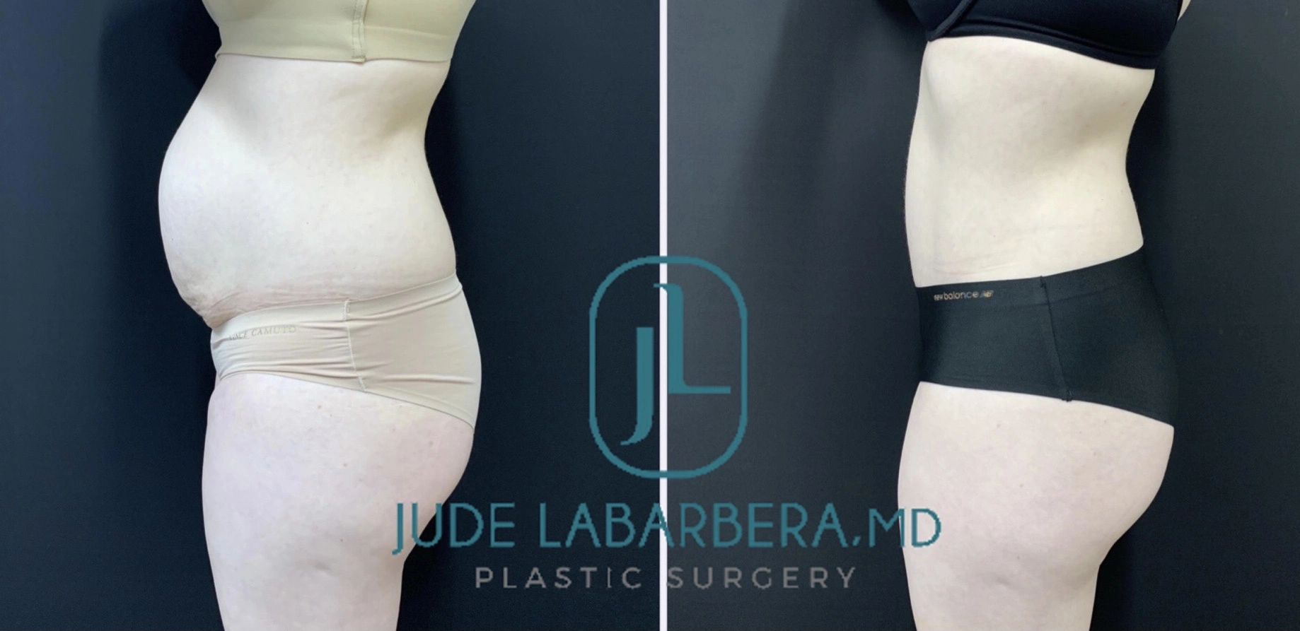 TUMMY TUCK Before & After Case Number 00090