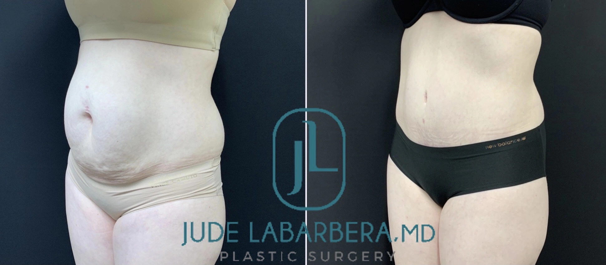 TUMMY TUCK Before & After Case Number 00090