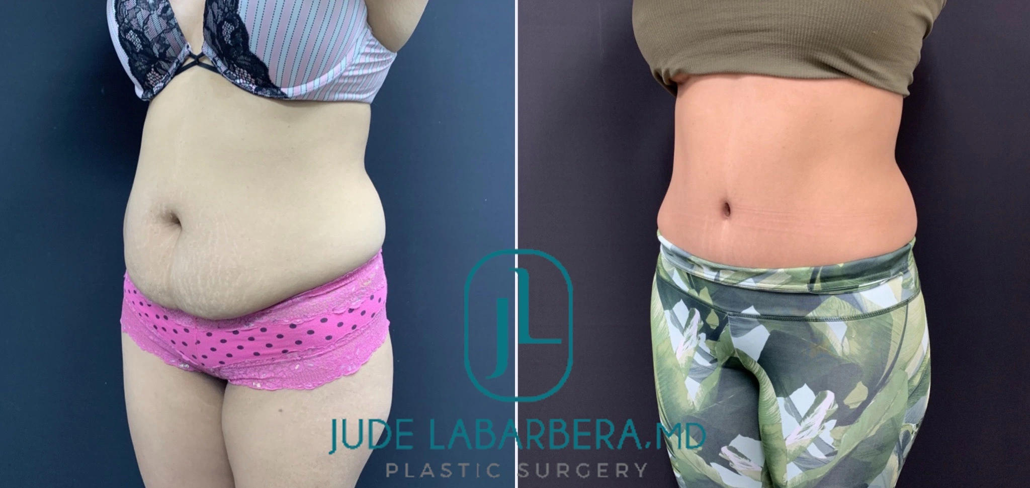 TUMMY TUCK Before & After Case Number 00091