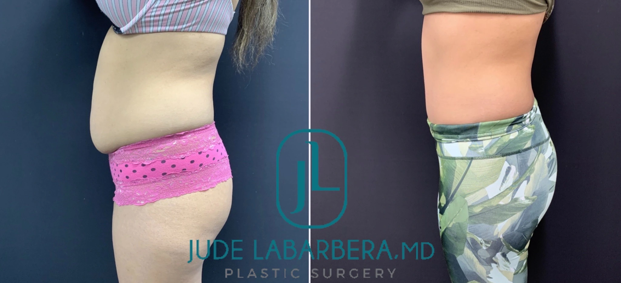 TUMMY TUCK Before & After Case Number 00091