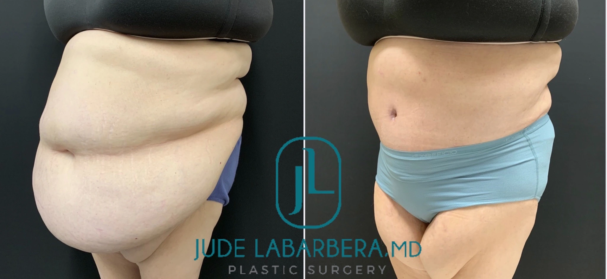 TUMMY TUCK ON PLUS SIZE PATIENT Before & After Case Number 000112