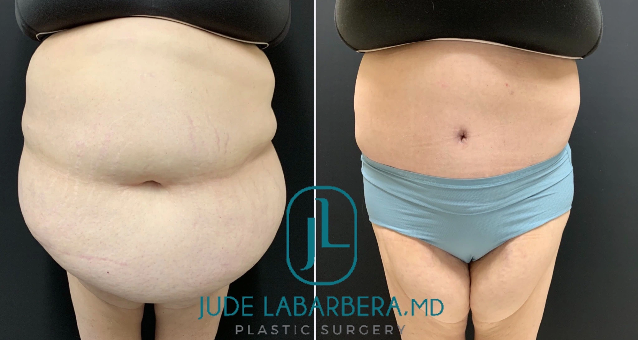 TUMMY TUCK ON PLUS SIZE PATIENT Before & After Case Number 000112
