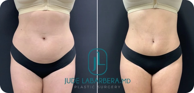 View Our Mini Tummy Tuck Results banner