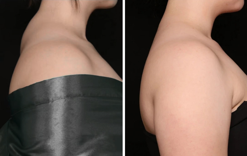 Before and after side profile showing reduced upper back fullness following buffalo hump removal liposuction