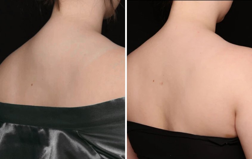 Before and after views of a patient's back and neck showing reduced buffalo hump after liposuction