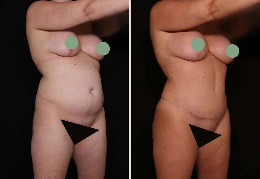 Tummy tuck before and after comparison showing abdominal contouring results