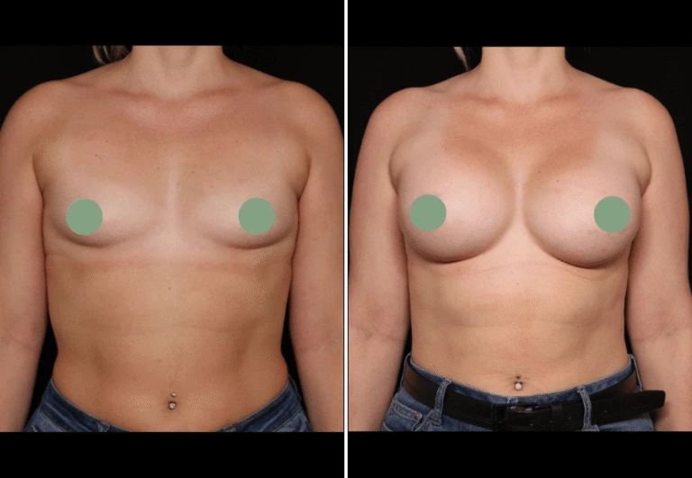 Before and after breast augmentation results showing increased volume and projection