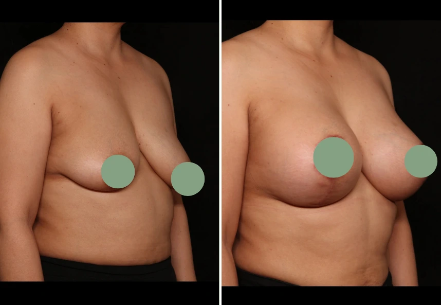 Breast lift before and after comparison showing improved lift and contour