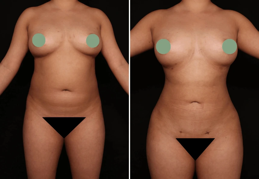 Before and after lipo 360 results showing front torso comparison with reduced abdominal fullness and improved waist definition
