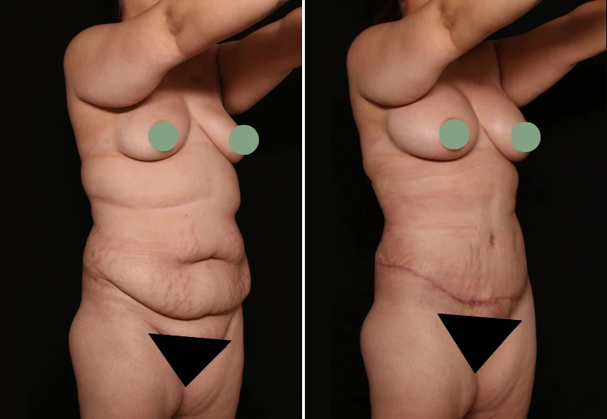 Mommy Makeover before and after results showing abdominal contouring and body sculpting