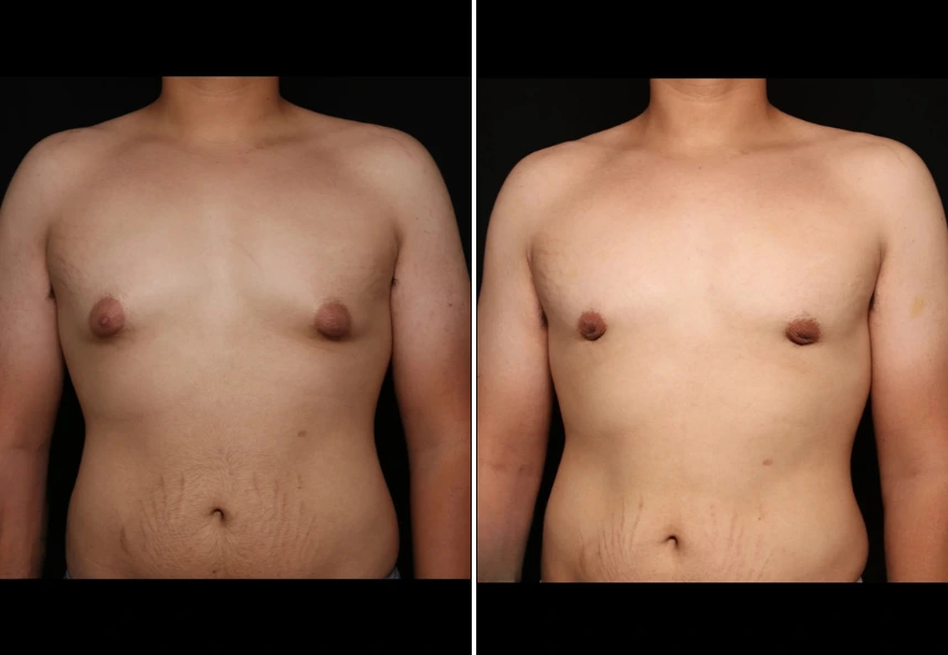 Gynecomastia surgery before and after result showing reduced breast tissue and improved chest contour