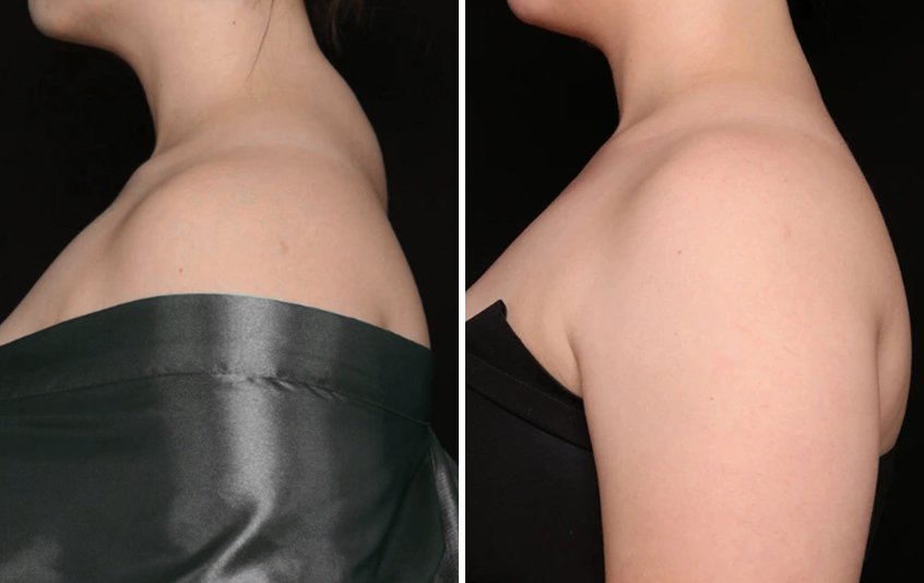 Before and after liposuction results showing improved body contour from side view