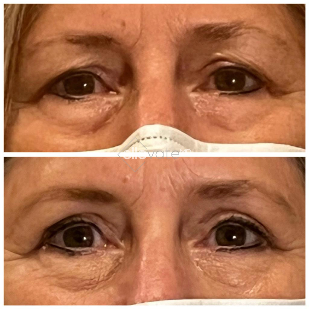 Cosmetic-Lid-Lift-Before-and-After-Image86 (1)